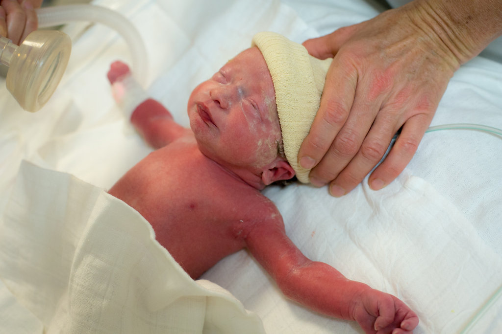 J1– 2h41. Malgré les injections de cortisone à la mère pour développer les poumons du fœtus, le bébé nécessite une aide respiratoire.